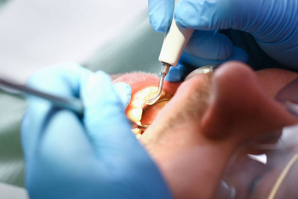 Best Emergency Tooth Extraction in Hernando, MS
