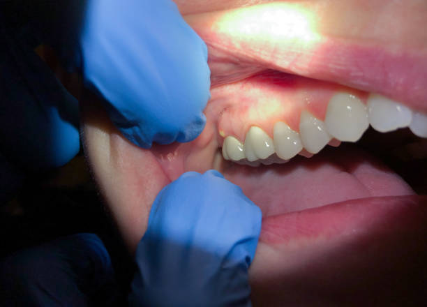 Best Emergency Dental Care for Broken or Chipped Teeth in Hernando, MS